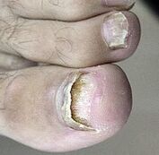 Lancé des champignons à ongles