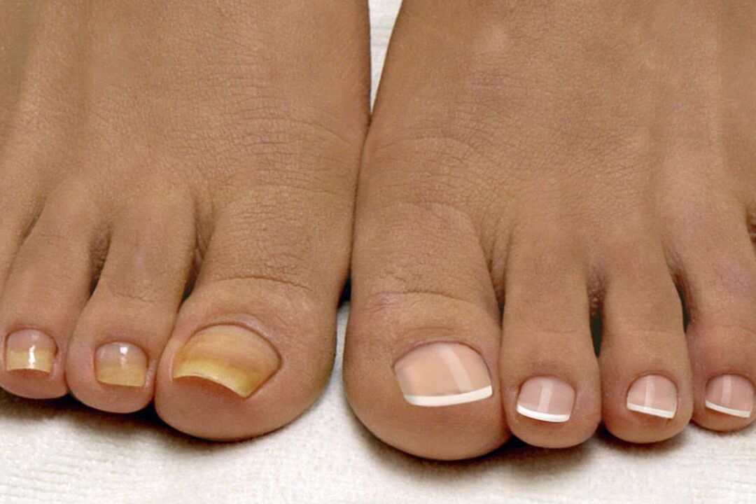 Sur une jambe saine ongles, de l'autre avec un champignon