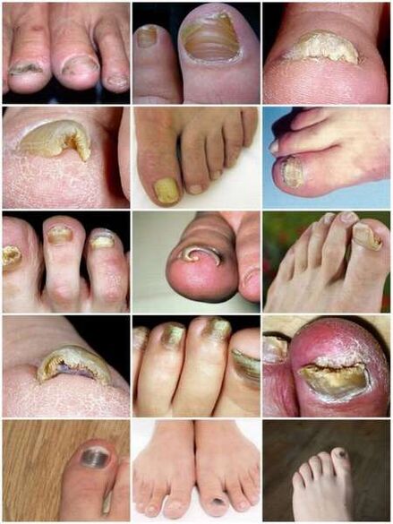 Infection fongique de la plaque de l'ongle