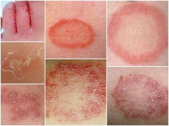 Trichophytose de la peau des jambes